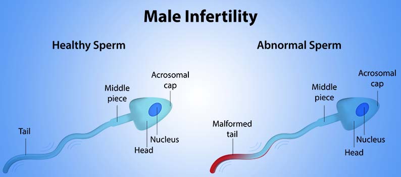 Anabolic Steroids and their Effect on Male Fertility